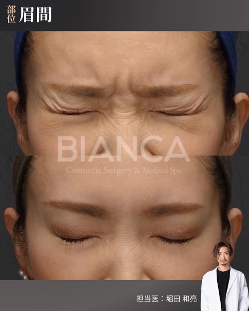 ボトックス（眉間）症例写真_ビフォーアフター_正面